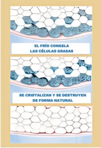 cómo funciona la criolipólisis (coolsculpting)