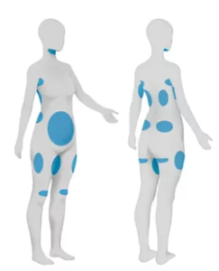 qué zonas se pueden tratar con criolipolisis (coolsculpting)