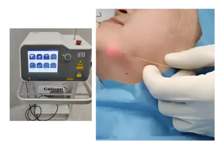 Lipolifting en La Vega Clinic Almería